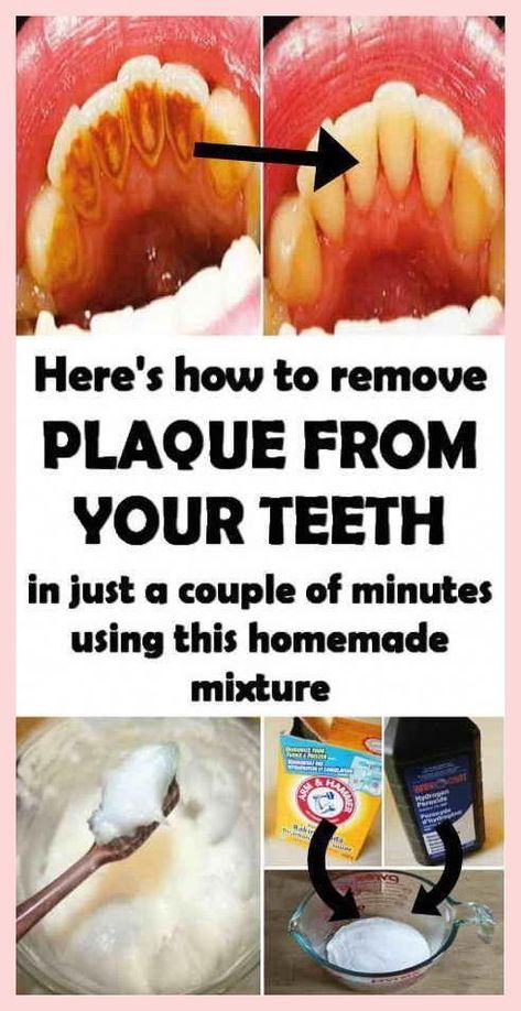 Remove Plaque From Your Teeth Just In 2 Minutes! Teeth Tartar Removal, Tartar Teeth, Homemade Mouthwash, Tartar Removal, Dental Plaque, Plaque Removal, Teeth Health, Dental Cleaning, Oral Care Routine