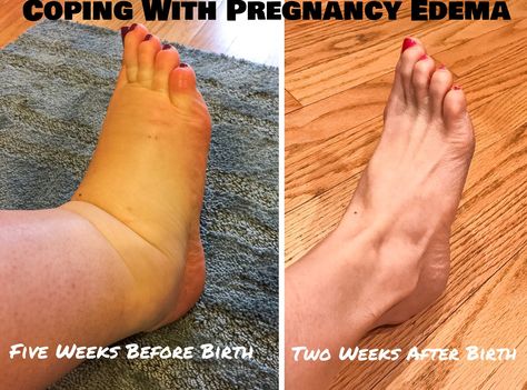 Postpartum Swelling, Swollen Feet Pregnancy, Swollen Feet Remedies, Swelling Remedies, Pregnancy Swelling, Postpartum Care Kit, Pregnancy Hacks, 32 Weeks Pregnant, Post Pregnancy Workout