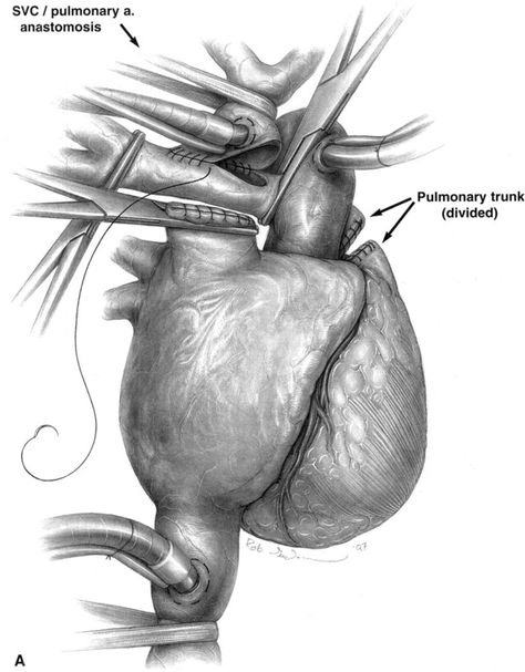 Extracardiac Lateral Tunnel Modification of the Fontan Procedure - Operative Techniques in Cardiac and Thoracic Surgery Superior Vena Cava, Central Venous Pressure, Thoracic Surgery, Prothrombin Time, Cardiology, Medical Illustration, Artist Inspiration, Surgery, Anatomy