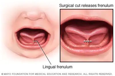 Tongue-tie (ankyloglossia) - Symptoms and causes - Mayo Clinic Tongue Health, Tongue Tie, Lactation Consultant, Oral Health Care, Mayo Clinic, Blood Vessels, Dental Health, Speech And Language, Oral Health