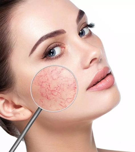 Latest Skin Healing Remedies, Redness On Face, Facial Veins, Home Remedies For Wrinkles, Permanente Make-up, Vein Removal, Brown Spots Removal, Sun Damaged Skin, Skin Spots