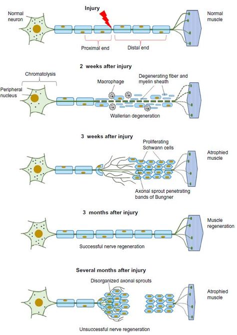 Figure 2 Cellular responses to nerve injury: nerve degeneration and regeneration. Neuroglia Cells, Superficial Peroneal Nerve, Nerve Regeneration, Zoology Notes, Nerve Structure, Afferent And Efferent Nerves, Peripheral Nerve Injury, Nerve Injury, Structure Of Neuron Diagram