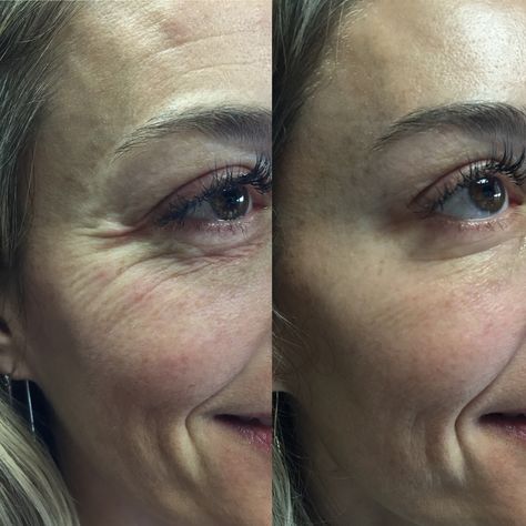 Botox Eleven Lines, Wrinkles Before And After, Botox Eyes, Botox Under Eyes, Gina Jones, Botox Wrinkles, Botox Before And After, Plasma Pen, Diy Lip Gloss