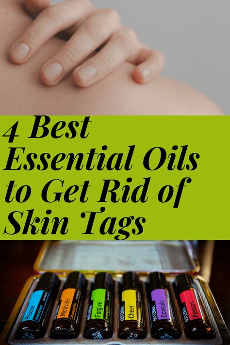 Oils For Skin Tags, Causes Of Skin Tags, Skin Tags Essential Oils, What Are Skin Tags, Best Essential Oils For Skin, Remove Skin Tags, Remove Skin Tags Naturally, Oregano Essential Oil, Skin Moles