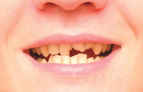 Chipped and cracked teeth are among the most common traumatic dental injuries. But teeth that are treated appropriately—and in a timely manner—have the best chance for a full recovery. #broken #tooth #emergency Broken Teeth, Cracked Tooth, Teeth Covers, Chipped Tooth, Healthy Life Hacks, Dental Emergency, Loose Tooth, Teeth Implants, Dental Veneers