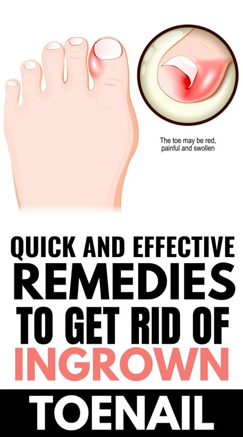 Toenail Pain, Infected Toenail, Toenail Fungal Infection, Nail Remedies, Nail Fungus Remedy, Ingrown Toenail, Nail Infection, Ingrown Nail, Fungal Nail