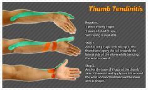 De Quervain's tendinitis occurs when the tendons around the base of the thumb are irritated or constricted. The word "tendinitis" refers to a swelling of the tendons. Thickening of the tendons can cause pain and tenderness along the thumb side of the wrist. #Ares #Tape #Kinesiology #Taping #JointPainrelief K Tape, Kinesio Tape, Kt Tape, Kinesio Taping, Wrist Pain, Psoas Muscle, Kinesiology Taping, Hand Pain, Hand Therapy