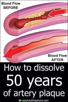 You may be at risk of a dangerous—even deadly— heart or brain disaster as a result of clogged arteries. But they don't have to stay that way! #HealthyHealthTips #DailyHealthTips Heart Or Brain, Artery Cleanse, Clogged Arteries, Health And Fitness Magazine, Healthy Diet Tips, Daily Health Tips, Soft Glam, Good Health Tips, Natural Health Remedies