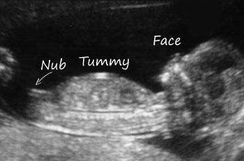 Nub Theory : Ingender.com 12 Week Ultrasound Pictures, 12 Week Ultrasound Gender, Ultrasound Boy Or Girl, 11 Week Ultrasound, Boy Ultrasound Pictures, Baby Gender Ultrasound, Ultrasound Gender Prediction, Boy Ultrasound, 12 Week Ultrasound