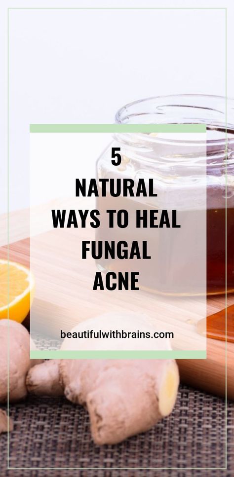 Forehead Acne, Fungal Acne, Acne Help, Natural Acne Remedies, Natural Acne, Acne Remedies, How To Get Rid Of Acne, Acne Skin, How To Treat Acne