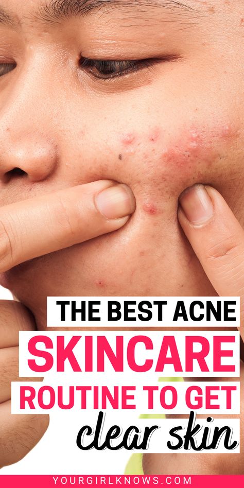 Teenage Acne Skincare Routine, Best Skin Care For Acne, Skincare Routine For Black Women, Best Cerave Products, Hormonal Acne Skincare Routine, Hormonal Acne Skincare, Acne Skincare Products, Teen Skincare Routine, Cerave Products