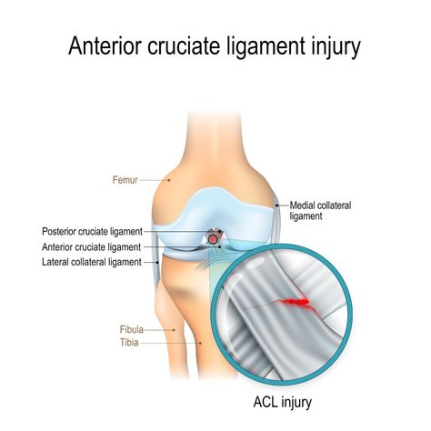 Anterior cruciate ligament injury diagram Knee Muscles Anatomy, Sprained Knee, Knee Muscles, Bursitis Knee, Joints Anatomy, Knee Pain Relief Remedies, Acl Injury, Muscles Anatomy, Patellofemoral Pain Syndrome