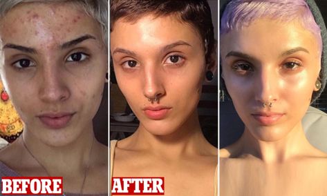 Woman shares before-and-after transformation of skin and reveals the regime that got rid of acne Skincare Routine Retinol, Tretinoin Before And After, Retinol For Beginners, Acne Aesthetic, Retinol Skincare Routine, Best Drugstore Skincare Products, Skin Care Routine Face, Retinol Body Lotion, Before And After Acne