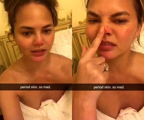 Celebrities Getting Real About Having Acne and Bad Skin | ELLE Australia Idols With Acne, Celebrities With Acne, Really Bad Acne, Celebs With Acne, Avoid Pimples Tips, Cystic Pimple, Bad Skin, Tinder Profile, Acne Memes Truths