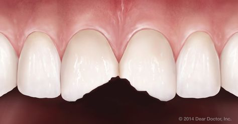 The most common type of dental injury is a chipped tooth. Fortunately, chips in teeth are usually quite easy to repair with dental bonding, veneers or crowns. #chipped #tooth Chipped Teeth Repair, How To Fix A Chipped Tooth, Chipped Tooth Repair, Tooth Crown, Chipped Tooth, Dental Bonding, Tooth Repair, Dental Insurance Plans, Discolored Teeth