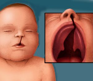 Cleft palate and cleft lip are the types of birth defects. It is a split or opening in the roof of the mouth. Due to cleft palate, people often suffer from feeding problems, speech problems, hearing problems, and frequent ear infections. Cleft Palate Speech Therapy, Cleft Lip And Palate Awareness, Digeorge Syndrome, Huntington's Disease, Oral Pathology, Cleft Lip And Palate, Cleft Palate, Integumentary System, Cleft Lip