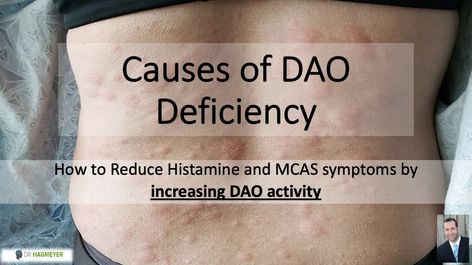 DAO Deficiency- How To Activate The Enzyme That Reduces Histamine Intolerance and MCAS Symptoms. | Dr. Hagmeyer Dao Boosting Foods, Mcas Symptoms, Antihistamine Diet, Histamine Intolerance Diet, Autonomic Dysfunction, Histamine Intolerance Symptoms, Mast Cell Activation, Low Histamine Foods, Histamine Diet