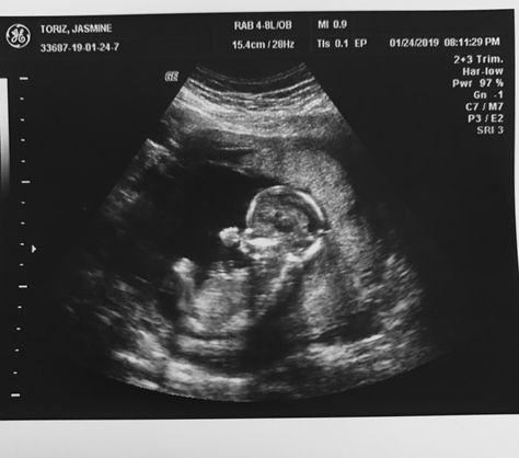 Hasil Usg Kandungan, 10 Weeks Pregnant Ultrasound, 9 Weeks Pregnant Ultrasound, Boy Ultrasound Pictures, Hasil Usg, Baby Gender Ultrasound, Boy Ultrasound, 12 Week Ultrasound, 16 Weeks Pregnant Ultrasound