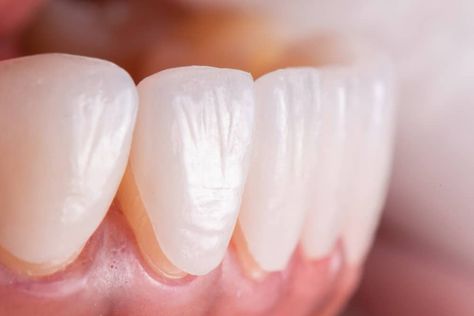 Veneer Teeth, Dental Ceramics, Composite Veneers, Veneers Teeth, Discolored Teeth, Aesthetic Dentistry, Porcelain Veneers, Dental Veneers, Smile Makeover