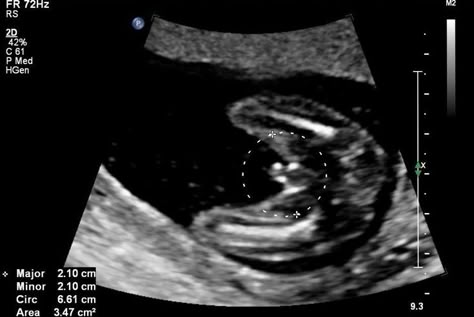 What Does a Baby Boy Look Like on Ultrasound?: Baby Boy at 18 Weeks Ultrasound Boy Or Girl, 15 Week Ultrasound, Boy Ultrasound Pictures, Baby Gender Ultrasound, Girl Ultrasound, Boy Ultrasound, Gyn Ultrasound, 16 Weeks Pregnant Ultrasound, Ultrasound Gender