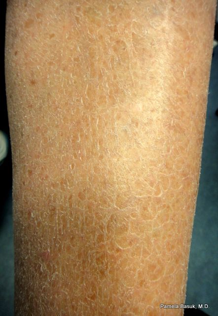 Scaly Legs Remedy Dry Skin, Dry Skin Legs Remedies, Dry Legs Remedy How To Get Rid, Super Dry Skin Remedies, Extreme Dry Skin Remedy, Scaly Skin Remedy, Dry Skin Legs, Dry Patchy Skin, Dry Scaly Skin