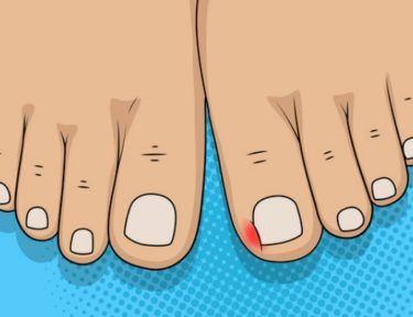 7 Rescue Remedies for Ingrown Toenails Ingrown Toenail Relief, How To Soften Toenails, Ingrown Toenail Remedy, Ingrowing Toenail, Nail Bed Damage, Ingrown Toenail Remedies, Toenail Pain, Fungal Infection Remedies, Infected Toenail