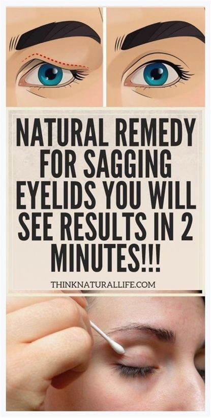 Natural Remedy for Sagging Eyelids — You Will See Results in 2 Minutes! Saggy Eyelids, Eye Health Remedies, Sagging Eyelids, Eye Diseases, Eye Makeup Application, Droopy Eyelids, Eyelid Lift, Health Plus, Facial Skin Care Routine