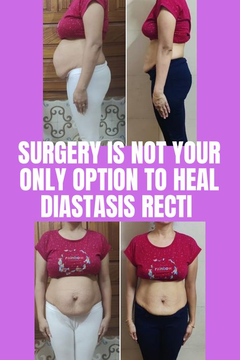 Are you a postpartum mom dealing with diastasis recti? Surgery is often seen as the only option, but there's more to consider. Discover the power of a structured nutrition and exercise routine tailored for diastasis recti. While surgery may be necessary for medical reasons or severe cases, many moms have found success with the Tummy Warrior coaching program, healing gaps from 2-6 fingers wide and even a fist-depth. #DiastasisRecti #PostpartumFitness #TummyTuckAlternativ via @beckychoi_Diastasis Severe Diastasis Recti, Diastasis Recti Repair, What Is Diastasis Recti, Heidi Powell, Healing Diastasis Recti, 6 Fingers, Diastasis Recti Exercises, Core Strengthening Exercises, Toned Tummy