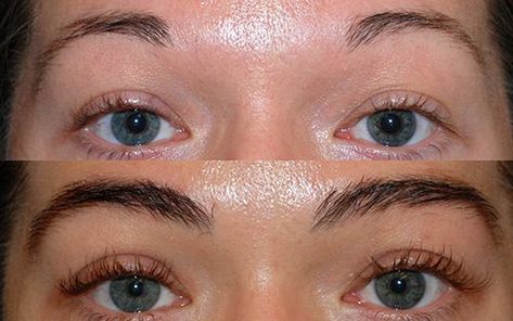 Eyebrow Implants, Eyebrow Hair Transplant, Losing Hair Women, Bad Wigs, Eyebrow Transplant, Hair Transplant Cost, Beautiful Eyebrows, Lost Hair, Hair Thickening