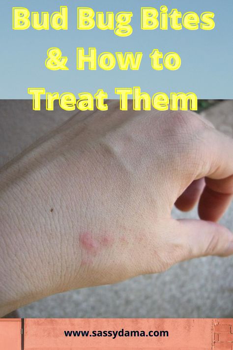 Bed bug bites can be very itchy, annoying, and embarrassing! Here are ways you can identify, prevent, and control bed bugs in your home. Red Bug Bites, Bed Bug Bites Remedies, Bed Bug Bites Pictures, Bed Bug Remedies, Bug Bites Remedies, Bug Bite Relief, Get Rid Of Bed Bugs, Bed Bug Spray, Bug Spray Recipe