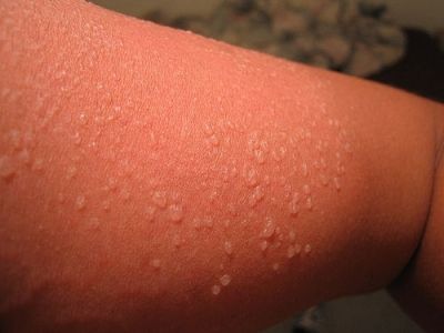 7 Ways to Treat a Sunburn …    I love summer time; the warmer weather, blue skies, swimming in the lake, going fishing, and taking part in other activities that are best … Sun Blisters, Water Blister, Sunburn Face, Sunburn Blisters, Blister Remedies, Get Rid Of Sunburn, Severe Sunburn, Home Remedies For Sunburn, How To Treat Sunburn