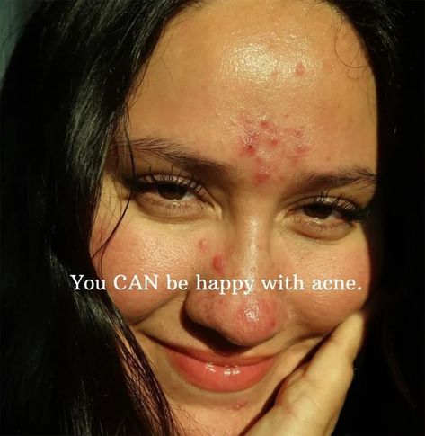 10 beauty influencers who embrace their acne and scars, proving you can feel beautiful just as you are 2 Bad Acne Pictures, Acne Is Beautiful Quotes, Embracing Acne, Acne Is Beautiful, Girls With Acne, Acne Pretty, Acne Aesthetic, Acne Photos, Beautiful Acne