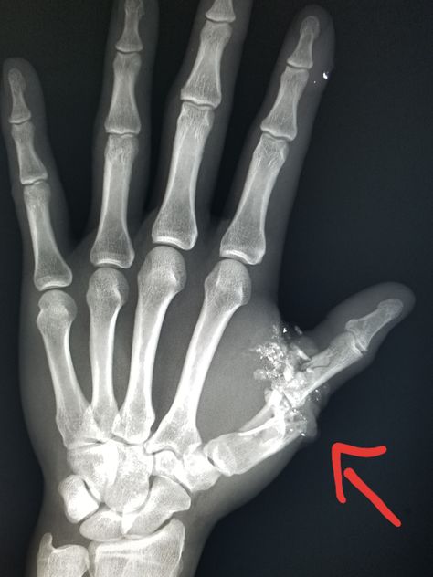 Hand xray: Florida man shot himself in the thumb. #radiologist #radiology #pain #trauma #injury #gsw  This information is for educational purposes. There is no individually identifiable health information. De-identification of protected health information has been performed. Skeleton Artwork, Xray Art, Mark Of The Beast, Bone Diseases, Theme Tattoo, Xray Tech, Anime Muslim, Hand Reference, Halloween Tattoos