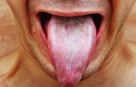 What Is That Nasty, White Film On Your Tongue? White Tongue Causes, Candida Overgrowth Symptoms, Candida Symptoms, White Tongue, Saccharomyces Boulardii, Candida Overgrowth, Small Intestine Bacterial Overgrowth, Abdominal Discomfort, Candida Albicans