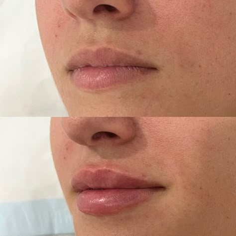 Perfect Lip Filler Shape, Very Subtle Lip Filler, Light Lip Filler Before And After, Lip Flip Inspiration, 0.55ml Lip Filler, Very Natural Lip Filler, Lip Injections Natural, Natural Botox Lips, Natural Full Lip Filler