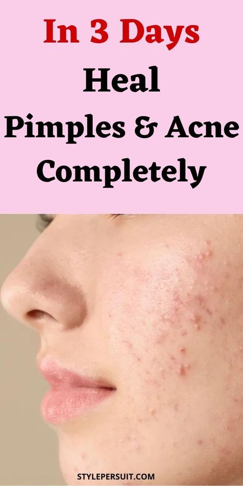 Do you really want to know how to get rid of pimples overnight fast? You have probably tried several pimple treatments and recommendations from friends without much success. You can now relax because we are going to give you effective pimple remedies that will help you say goodbye to pimples once and for all. Whether you have pimples on face, pimples on scalp, chin, on buttocks, or under the skin, you will be able to remove them easily. Click to get these effective pimple remedies overnight. How To Rid Of Acne, Natural Pimple Remedy, Pimples On Face Removal, How To Get Rid Of Pimples Fast, Pimples On Face Meaning, How To Get Rid Of Pimples Overnight, Pimple Remedies Overnight, Hard Pimple, Pimple Remedies