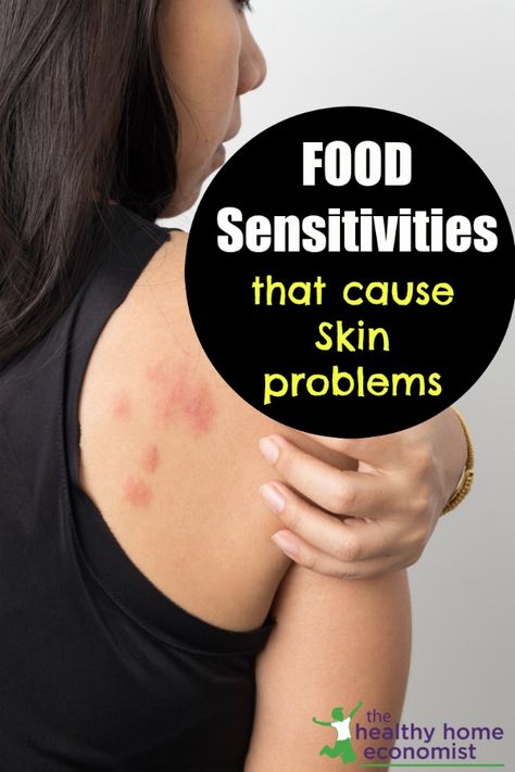 Check out this post from The Healthy Home Economist and learn how food can affect your skin. Food sensitivities are dramatically on the rise and the same can be said for skin disorders. Looking back even a decade ago, being sensitive to some kinds of food was not the hot topic that it is today. Going back 50 years ago, it was virtually unheard of! #healthy #foodsensitivities #skinproblems #causes #issues #skin Autoimmune Skin Disorders, Psoriatic Skin Diet, Food Allergy Rash, Cosmetic Nursing, Being Sensitive, Remove Skin Tags Naturally, Histamine Intolerance, Gluten Allergy, Cold Sores Remedies