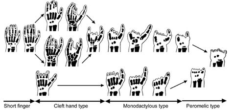 Symbrachydactyly. (sim-brak″e-dak´tĭ-le) occurs during normal embryonic development. This hand disorder characterized by abnormally short fingers that are sometimes webbed or conjoined. This limb difference occurs in every 30,000 to 40,000 births. Limb Difference Awareness, Short Fingers, Limb Difference, Embryonic Development, Hand Type, Relatable Quotes, Healing, Band, Quotes