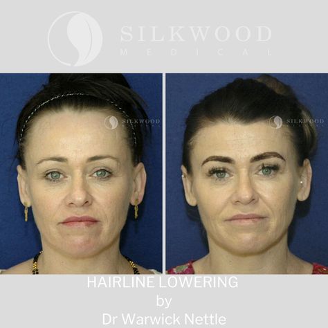 Hairline lowering surgery otherwise known as forehead reduction surgery rejuvenated my patients face and feminised her features. A high hairline in women can look ageing and masculine. To find out more about this great procedure contact our rooms and speak to Marika or Michelle.  T: (02) 9387 3900 W: www.silkwoodmedical.com.au E: reception@silkwoodmedical.com.au   #hairline #hairlineloweringsurgery #hairlinelowering #foreheadreduction #foreheadreductionsurgery #drnettle #drwarwicknettle Forehead Reduction Surgery, Forehead Reduction, Reduction Surgery, Cute Casual Outfits, Surgery, How To Find Out, Casual Outfits, Medical, Quick Saves