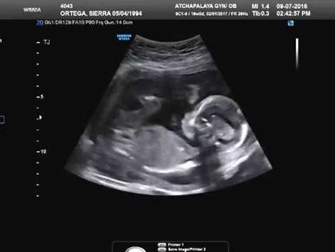 baby girl ! 19 Weeks Pregnant Ultrasound, 20 Week Ultrasound Pictures, 20 Weeks Pregnant Ultrasound, 11 Weeks Pregnant Ultrasound, 12 Week Ultrasound Pictures, 17 Weeks Pregnant Ultrasound, 12 Week Ultrasound Gender, Ultrasound Boy Or Girl, Ultrasound Pictures Gender