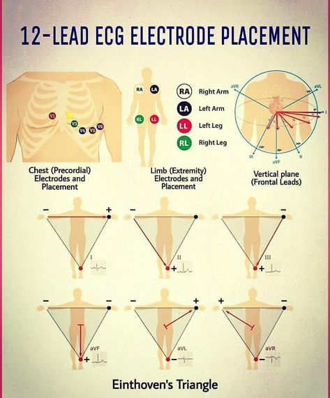 12 - lead ECG Electrode Placement Ekg Lead Placement Cheat Sheets, 12 Lead Ekg Cheat Sheet, Ekg Placement 12 Lead, Ecg Lead Placement, 12 Lead Ekg Placement, Ekg Placement, Medical Assistant Notes, Paramedic Notes, Medic School