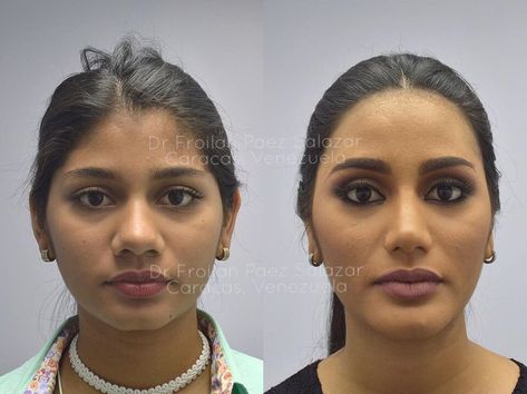 Second runner-up in Miss Universe pageant thanks plastic surgeon for ‘excellent work’ in viral post showing before-and-after photos  https://www.businessinsider.sg/second-runner-up-in-miss-universe-pageant-thanks-plastic-surgeon-for-excellent-work-in-viral-post-showing-before-and-after-photos/ Makeup Transformation Tutorial, Nose Plastic Surgery, Face Transformation, Rhinoplasty Nose Jobs, Pageant Makeup, Skin Tone Makeup, Rhinoplasty Before And After, Miss Venezuela, Beauty Procedures