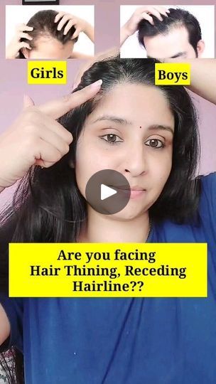 328K views · 9.9K reactions | 🌟Bald patches, thining hairline, big forehead problems then use this home made ginger gel...

Plz do patch test ....
Always use onion juice in dilute form if you are not use to this . this is the safest option to use this....

How I prepare this ✅✅✅
ginger 1 inch
Onion 1/2
Aloe vera gel 1 tsp
Castor oil 1/2 Tsp or Rosemary oil

Benefits ✅ 
Helps in hairregrowth 
Promotes hair growth
Prevents dandruff 
Control hair fall
Prevents scalp infection 

❤Plz focus on healthy diet & keep your scalp clean n healthy and go for this Homeremedies....

❤Use 2 times a week before hairwash....keep it for 1 hr n wash off with mild shampoo....
.
.
Like & Save ❤❤❤
Follow for more @beauty_secrets_with_shalini ❤❤❤
.
.

.
#hairoil #hairoils #hairgrowth #hairgrowthoil #hairgrowthoi Forehead Hair Growth Tips, Forehead Hair Growth, Forehead Hair, Hair Fall Solution, Onion Juice, Bald Patches, Dry Skin Remedies, Hair Dandruff, Hair Remedies For Growth