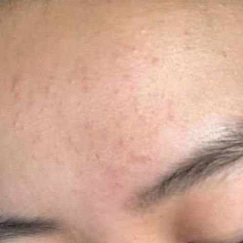 Redditor Shares Transformative Fungal Acne Routine — See Her Before & After Photos | Allure Products For Fungal Acne, Fungal Acne Remedies, What Is Fungal Acne, How To Get Rid Of Fungal Acne, Get Rid Of Fungal Acne, Treat Fungal Acne, Acne Routine, Fungal Acne, Forehead Acne