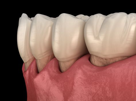 The sooner gum recession is caught, the easier it is to treat and reverse the damage because receding gums won't regenerate on their own. Reverse Receding Gums, Gum Graft, Gum Surgery, Gum Recession, Implant Dentistry, Tooth Extraction, Periodontal Disease, Receding Gums, Healthy Smile