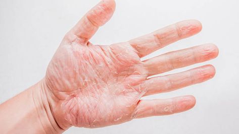 Invigorate your dry peeling hands this summer with these soothing remedies. Will you try this trick? Itch Relief, Bacterial Infection, Fungal Infection, Peeling Skin, Flaky Skin, Dry Hands, Skin Cream, Dead Skin, Skin Care Tips