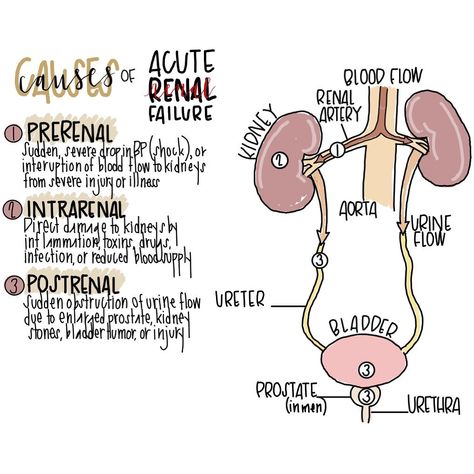 K Y M B E R L Y🩺 on Instagram: “🚨 FREEBIE 🚨 Causes of Acute Renal Failure Feel free to SHARE with your friends and tag @studywithkym ! 📝 Hand drawn with love🌿 #student…” Renal System Nursing, Med Surge, What Is Intelligence, Nursing School Notes, 2nd Year, Future Nurse, Nursing Notes, Post Instagram, Med School