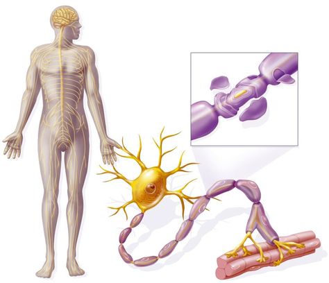 Ms Disease, Neurological Disabilities, Optic Nerve, Feeling Dizzy, Mri Scan, Physical Disabilities, Central Nervous System, Spectrum Disorder, Autoimmune Disease