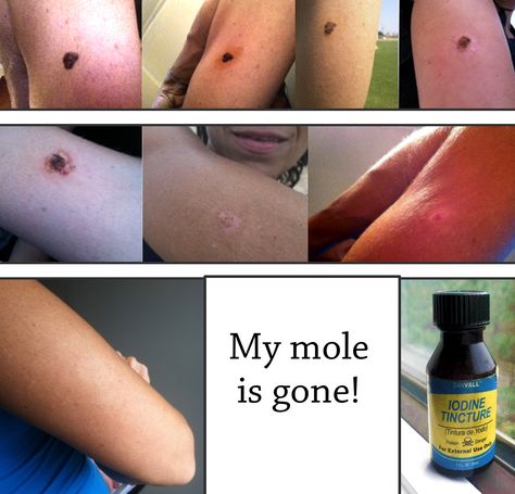 It took a few months but 2% iodine removed my arm mole completely. All you need is a little bottle of iodine, and some castor oil Castor Oil For Mole Removal, Remove Moles Naturally, How To Remove Moles, Skin Tags On Face, Remove Moles, Remedies For Skin, Remove Skin Tags Naturally, Clean Baking Pans, Home Remedies For Skin