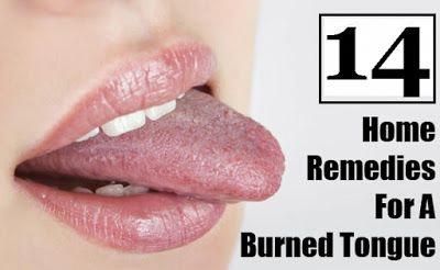 14 Home Remedies for Burning Tongue, Home Remedies for Burning Tongue, How to do after Burning Tongue, home remedies, Burning Tongue, Burnt Tongue Remedies, Burning Tongue, Burnt Tongue, Tongue Sores, Burn Remedy, Remedies For Dry Mouth, Mouth Health, Tongue Health, Top Diy